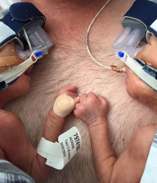 Precious Premature Twins Do The Most Adorable Thing In Their First Hours Of Life